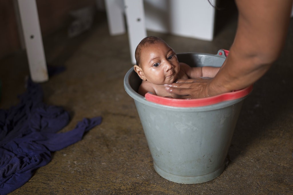 2015年，巴西一名因茲卡病毒而罹患小頭畸形的嬰兒（圖／美聯社）

 

