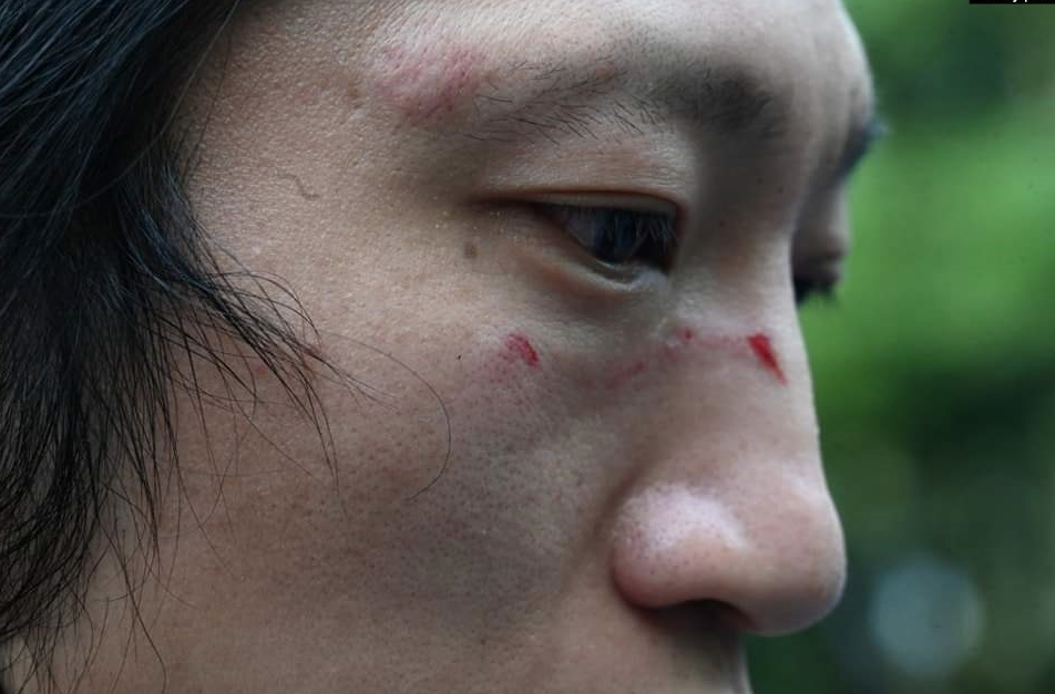 Một người biểu tình có tên "Bob" khoe vết thương của mình sau khi bị nhân viên lãnh sự quán Trung Quốc ở Manchester, Anh đánh đập.  (VOA, & nbs ...