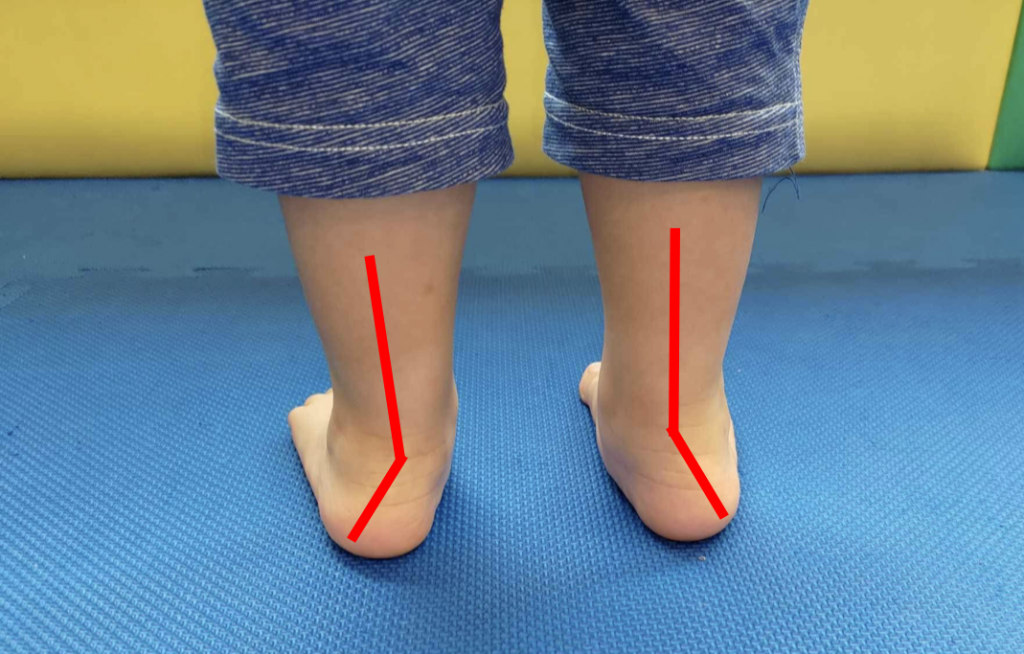 薛千川醫師說明，從後方觀察孩子的足跟，若足跟往外側彎曲，就可能是扁平足。（恩主公醫院提供）
