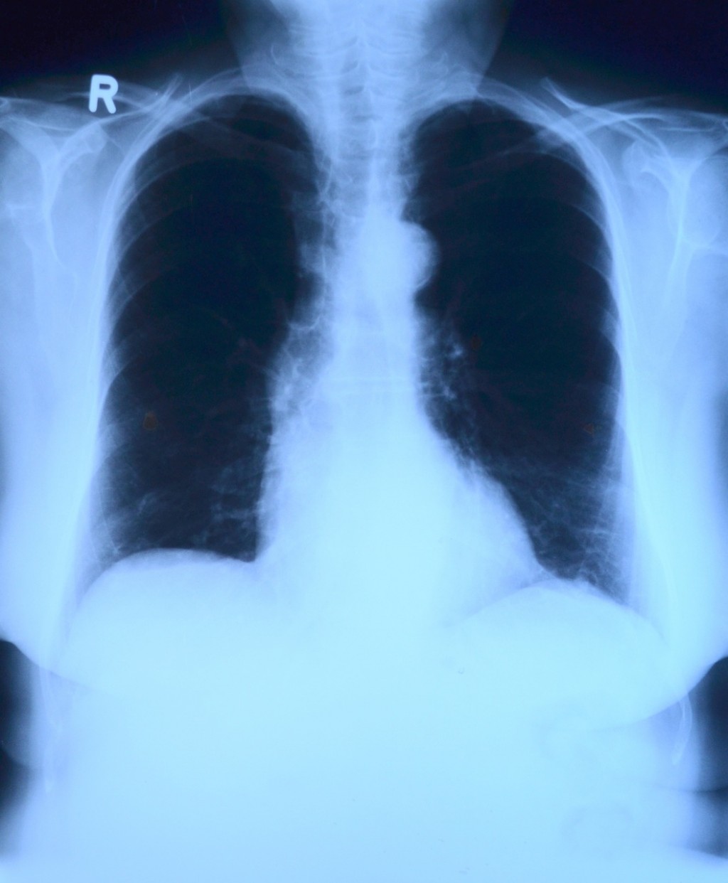 醫師強烈建議應從傳統胸部X光檢查轉向更先進的LDCT肺癌篩檢，落實早期診斷。（圖／pixabay）
