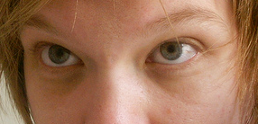 黑眼圈示意圖。（圖／維基百科）
