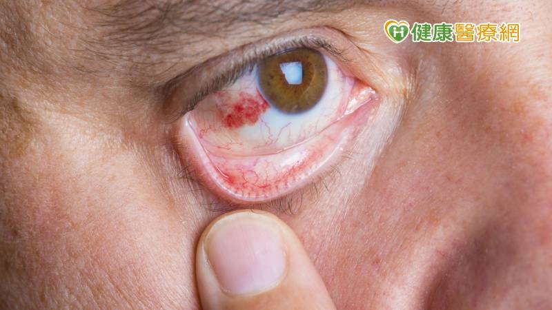 眼睛紅紅的「結膜下出血」是中風前兆？　眼科醫破解迷思