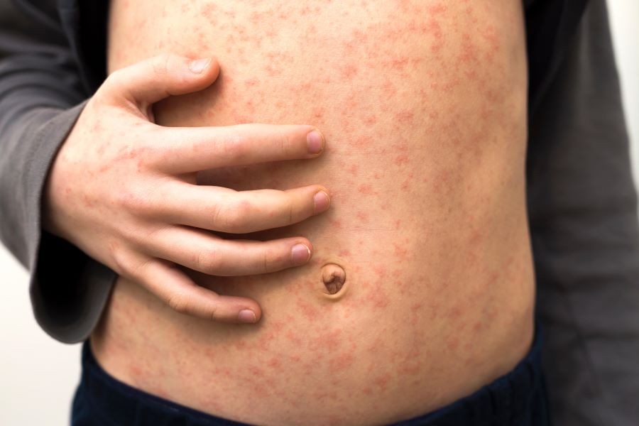 Photo illustrative of measles. (Reuters, Andrii Biletskyi/Alamy photo)
