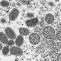 猴痘病毒擴散至中東　台灣疾管署籲3症狀提高警覺
