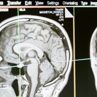 提早預測心血管疾病不是夢！陽明交大用MRI+AI算出腦神經血管年齡