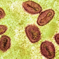 Taiwan reports 1st Mpox death